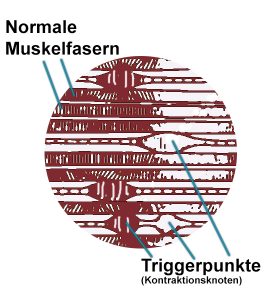 Triggerpunkte